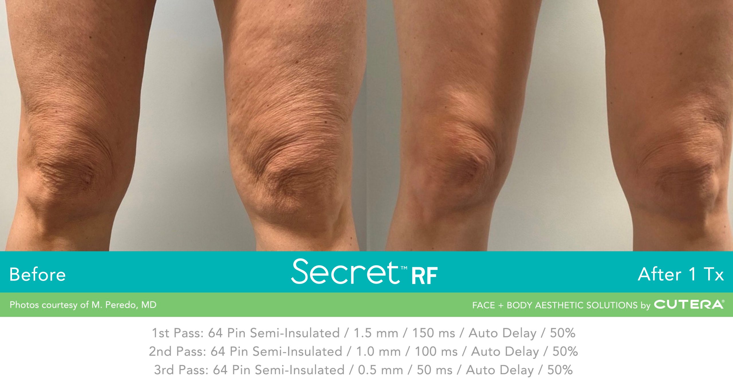 Knees smoother skin