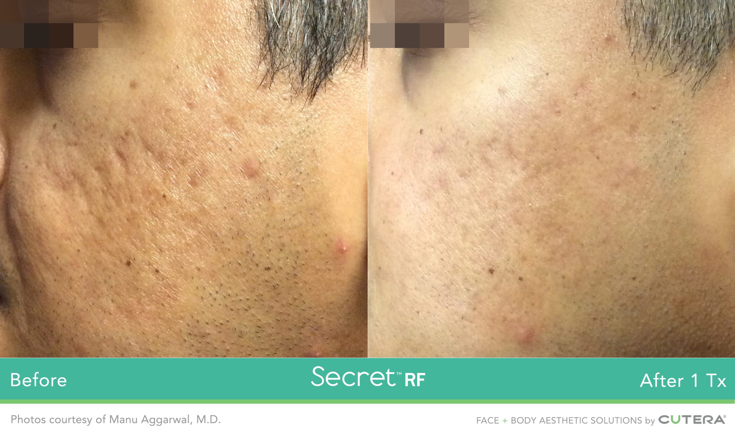 acne scars reduced