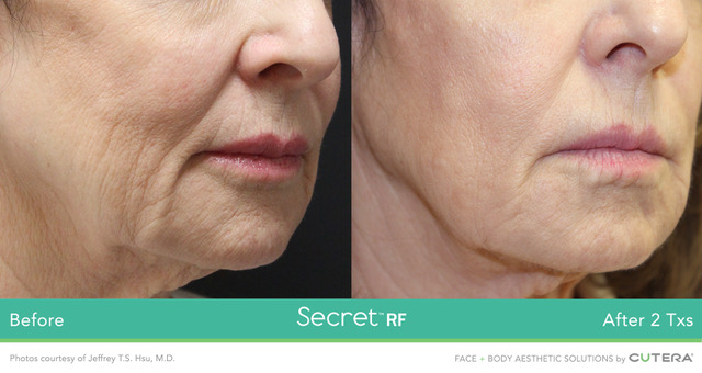 Secret RF Skin tightening treatment