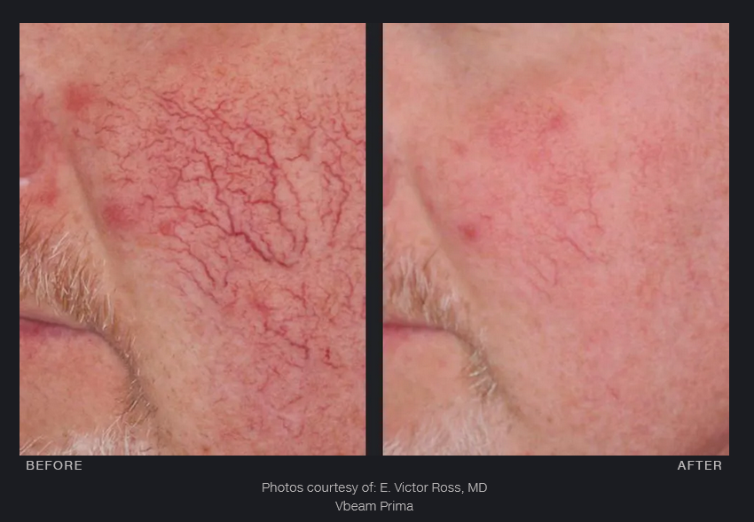 Red capillaries treated with Vbeam Prima Laser