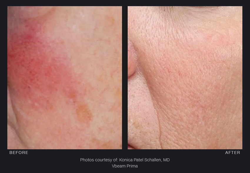 Pigment removal treated with Vbeam Prima Laser